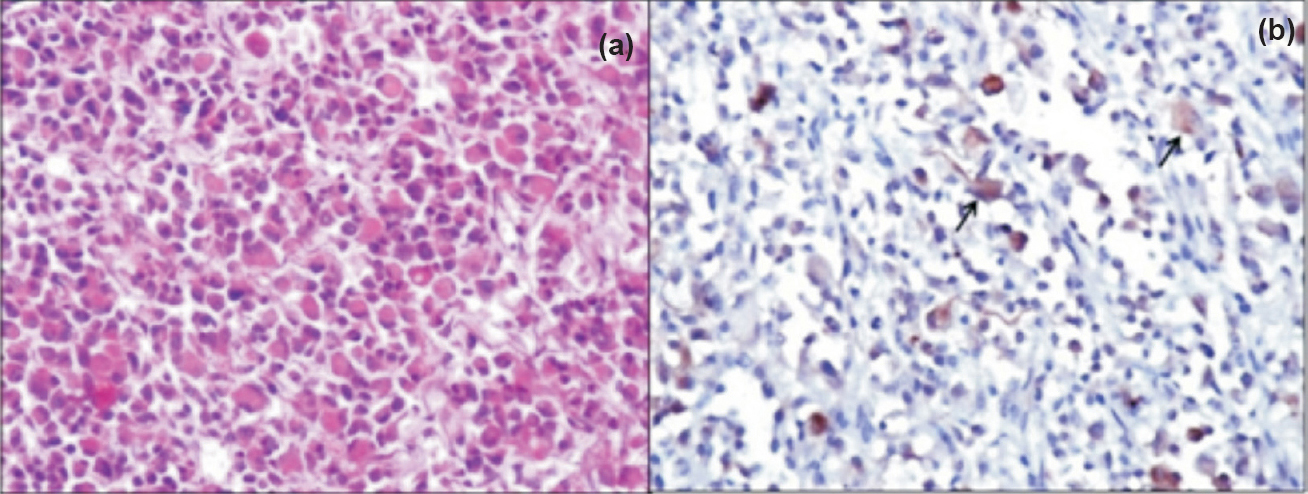 (a). A case of malignant rhabdoid tumour in a 3 month old boy (H&Ex200). (b) WT1 immunostaining shows cytoplasmic WT1 expression in rhabdoid cells (arrows) (Immunostain x200).